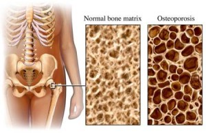 OSTEOPOROSI-COP